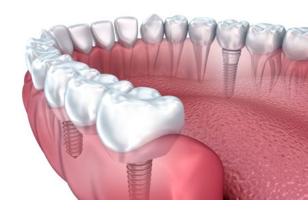 Austin teeth implant