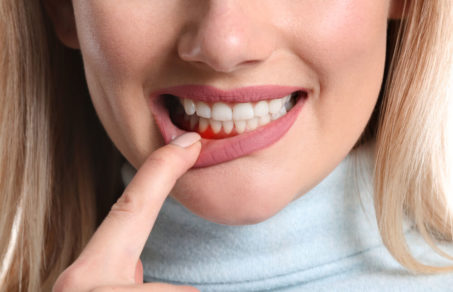 Woman using right hand finger to pull lower lip down and show swollen gum due to periodontitis