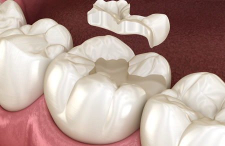 dental inlay is the best option
