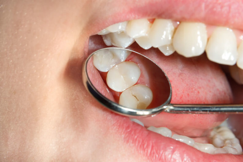 What Are Dental Sealants