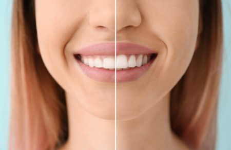 Gum Contouring Results