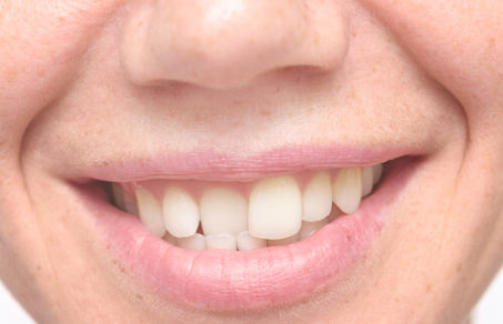 Man adult with crooked teeth