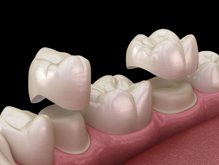 picture of dental crowns being placed on teeth