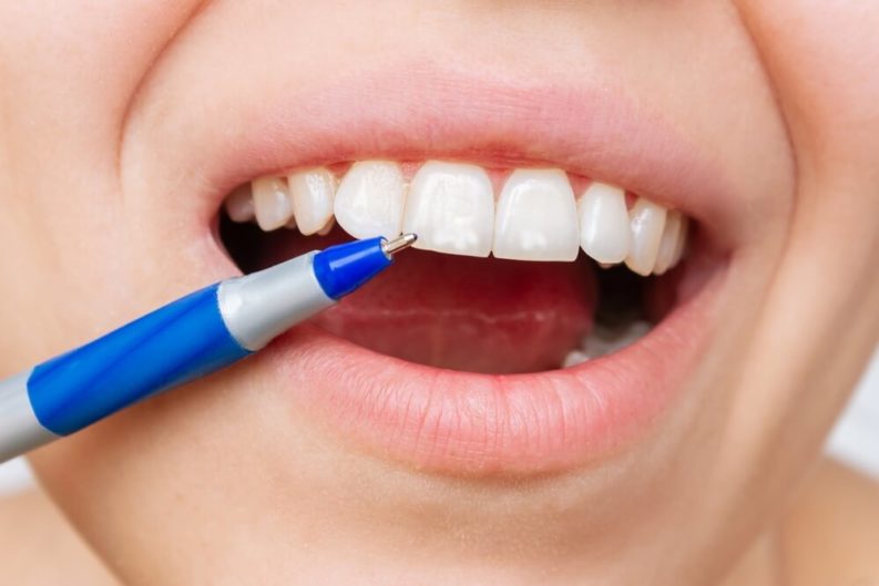 Person pointing to a white spot on her top front tooth with the tip of a blue pen