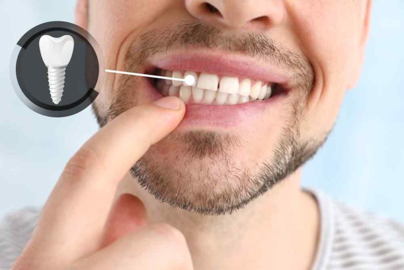 Man smiling pointing with his finger which of his teeth is an implant and a small image with an implant icon emerges from that tooth
