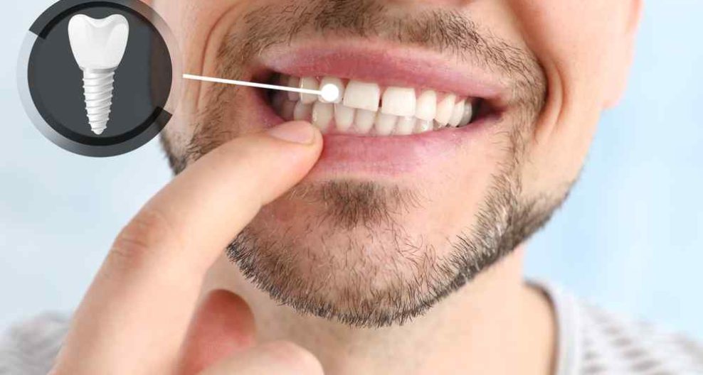 Man smiling pointing with his finger which of his teeth is an implant and a small image with an implant icon emerges from that tooth